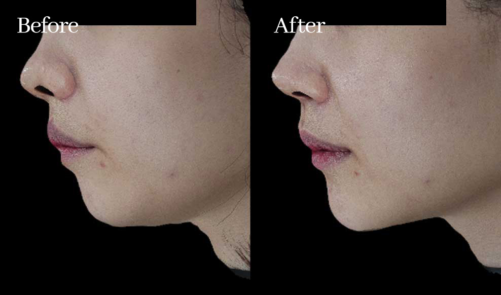 섬세한 슬로아 리프팅