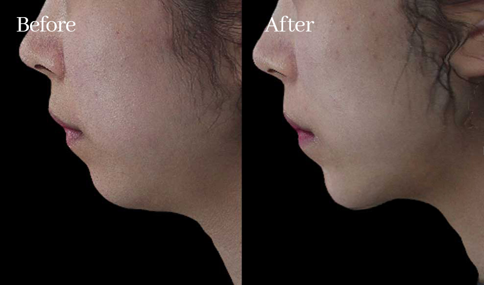 슬로아 시그니처 4