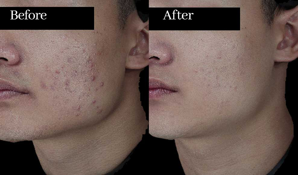 여드름/흉터 개선